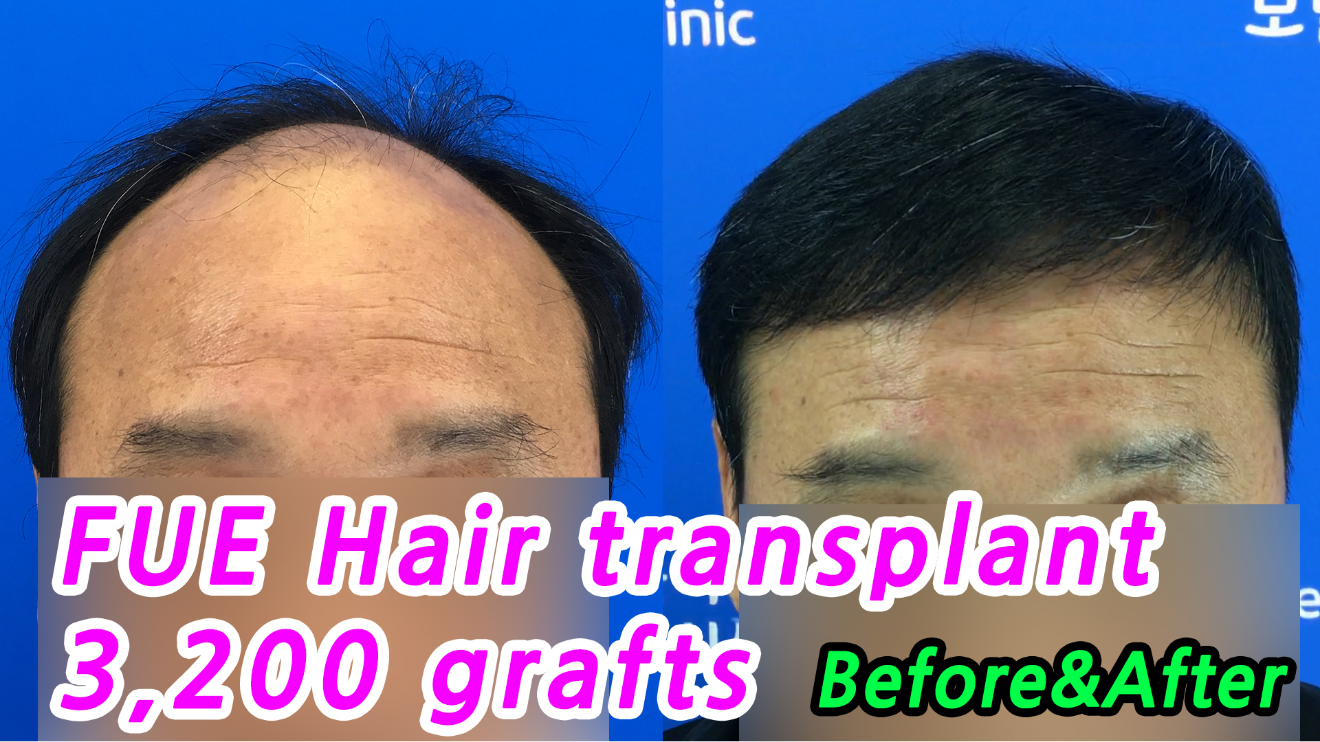 ▷☞Play video☜◁FUE Hair Transplant in Korea (3,200 Grafts)_Before&After